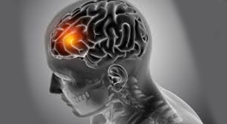 Paralysis, stroke become more common in colder months: Medical expert -INP  Independent News Pakistan